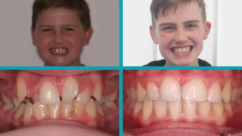 Fixed Braces treatment result