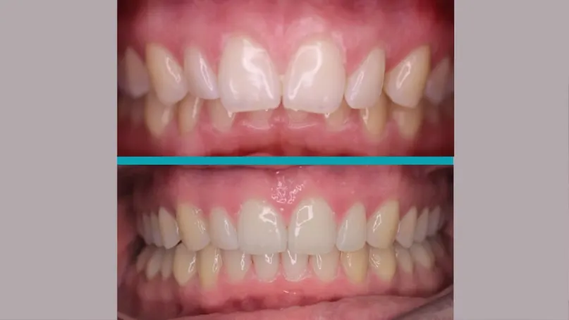 Invisalign treatment result