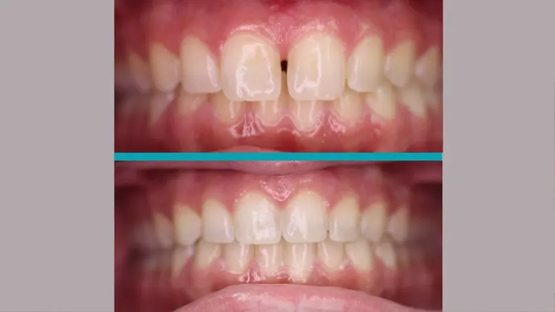 Fixed Braces treatment result