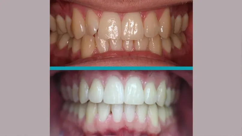 Fixed Braces treatment result