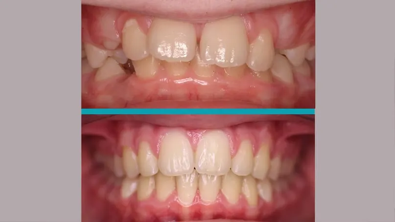 Fixed Braces treatment result