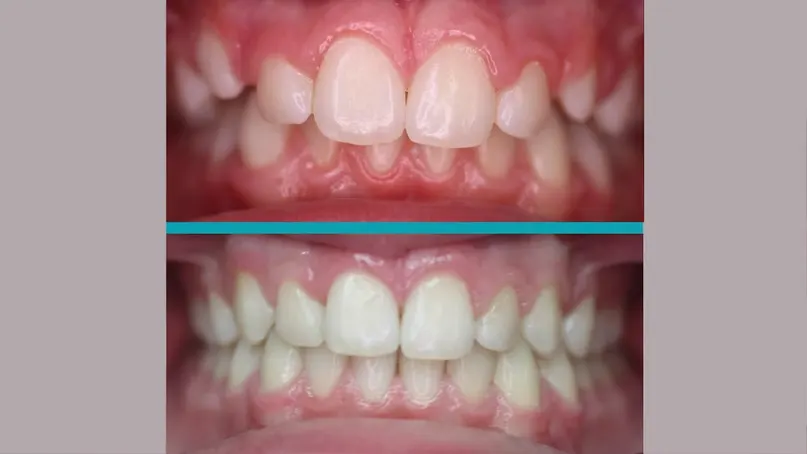 Invisalign treatment result