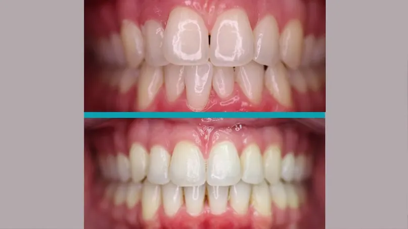 Invisalign treatment result
