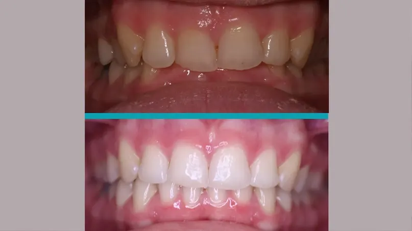 Invisalign treatment result