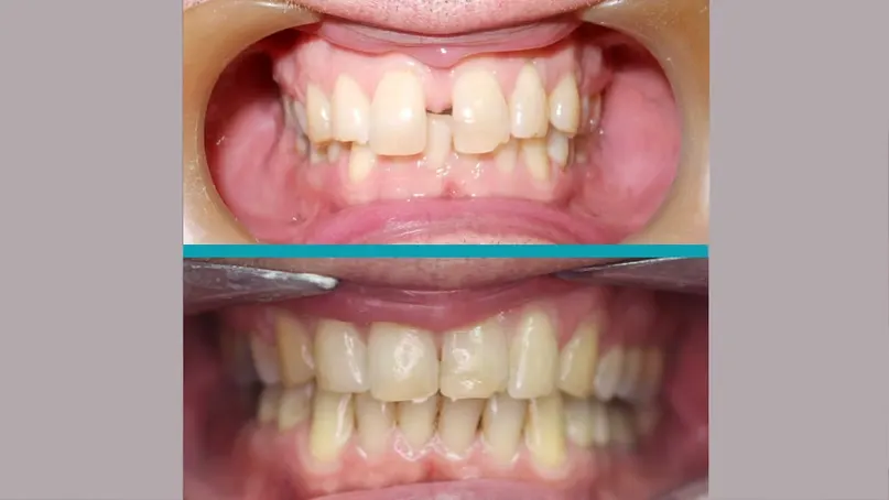 Fixed Braces treatment result