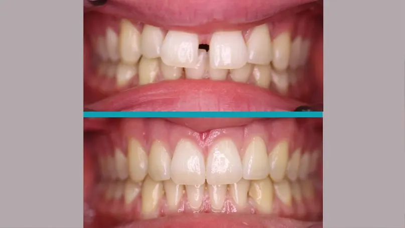 Invisalign treatment result