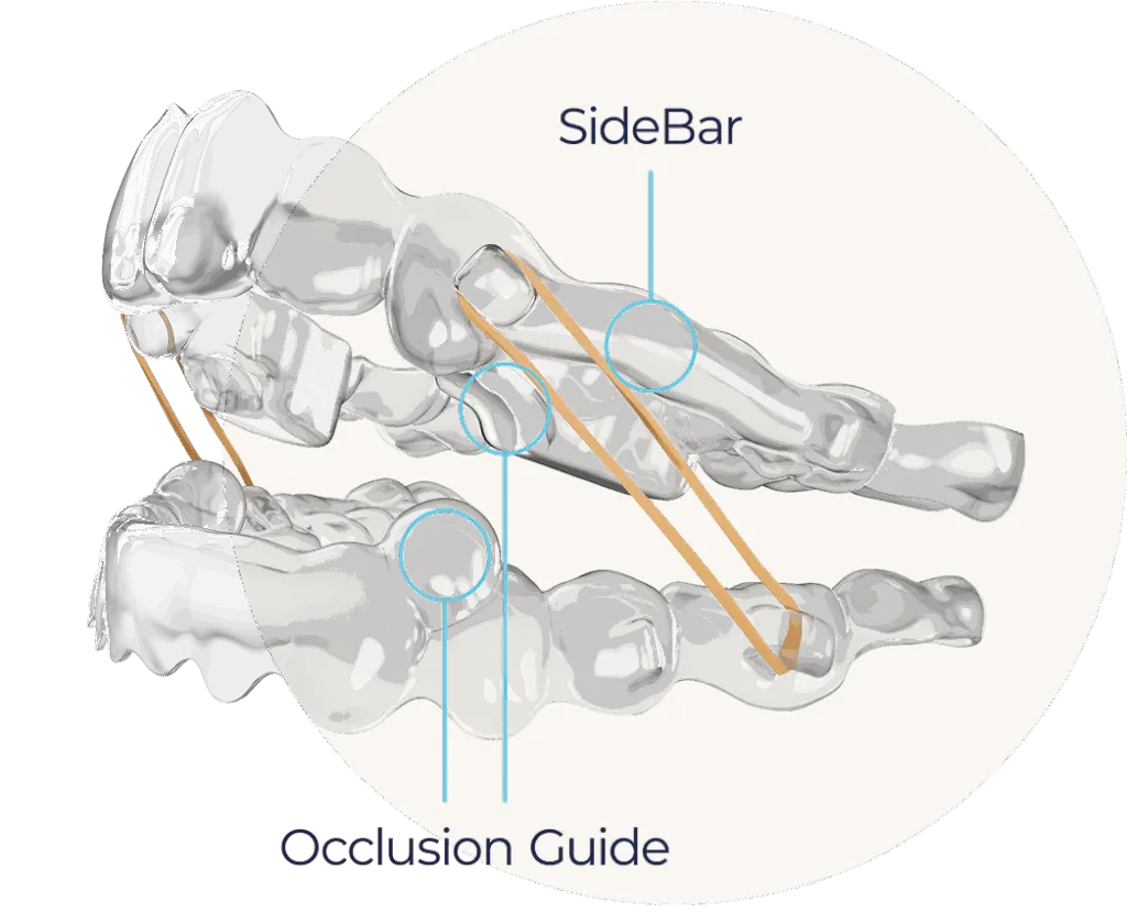 Diagram of a clear aligner with the SideBar and Occlusion Guide features labelled