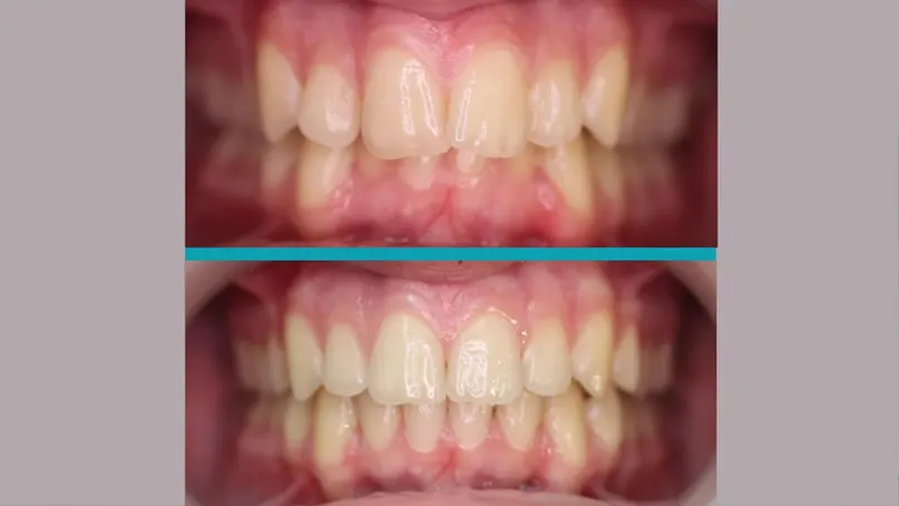 Invisalign treatment result