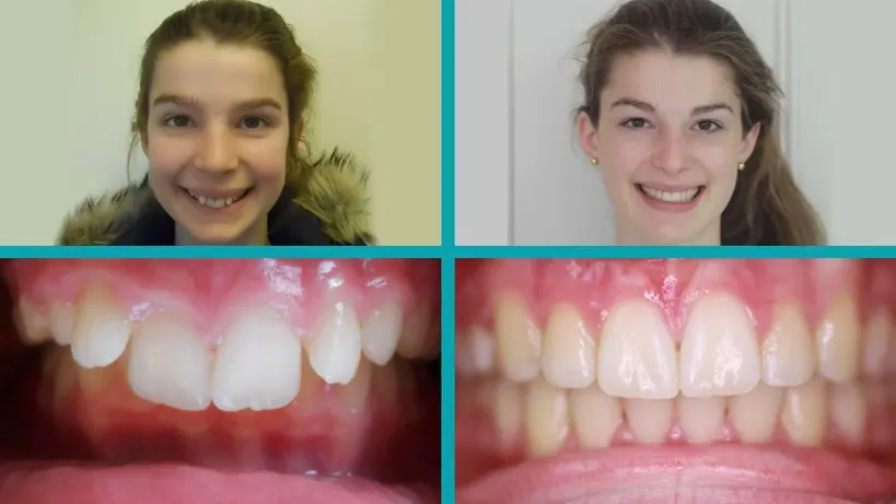 Fixed Braces treatment result