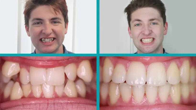 Fixed Braces treatment result
