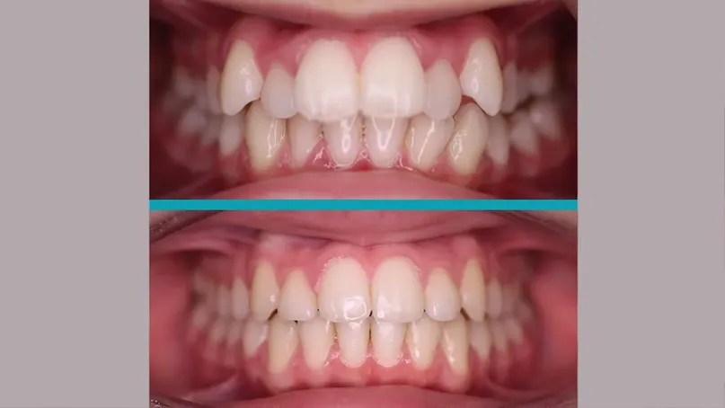 Fixed Braces treatment result