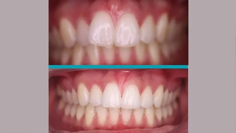 Invisalign treatment result