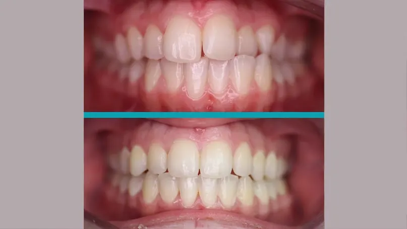 Fixed Braces treatment result