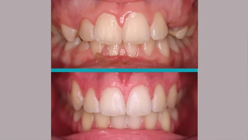 Fixed Braces treatment result