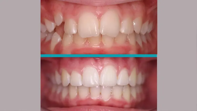 Fixed Braces treatment result