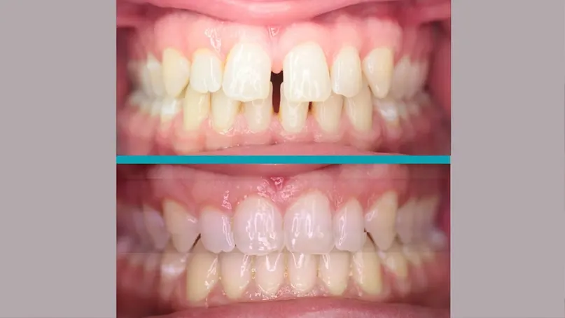 Invisalign treatment result