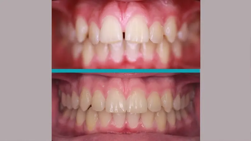 Fixed Braces treatment result