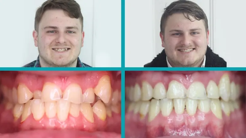 Invisalign treatment result