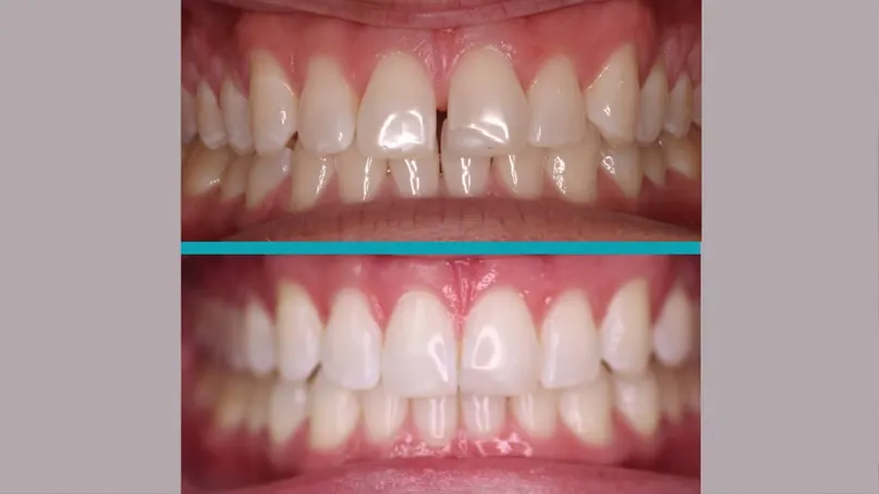 Invisalign treatment result