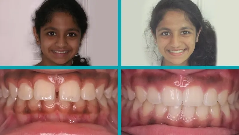 Fixed Braces treatment result