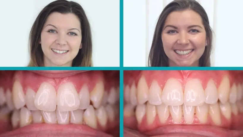 Invisalign treatment result
