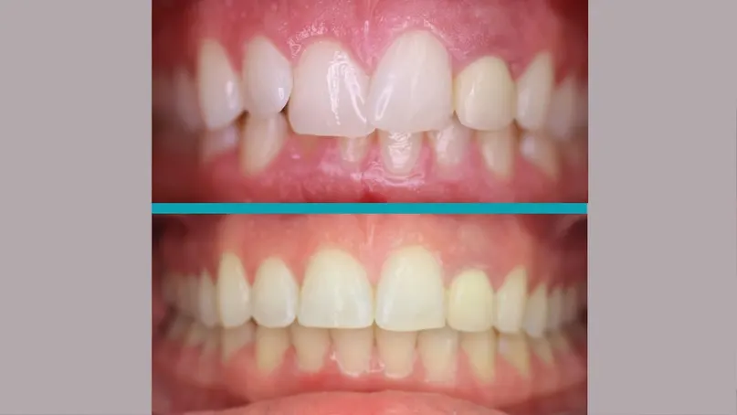Fixed Braces treatment result