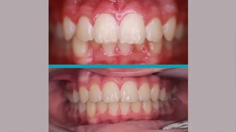 Fixed Braces treatment result