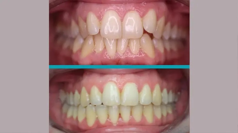 Fixed Braces treatment result
