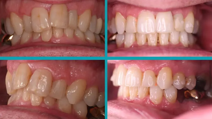 Invisalign treatment result