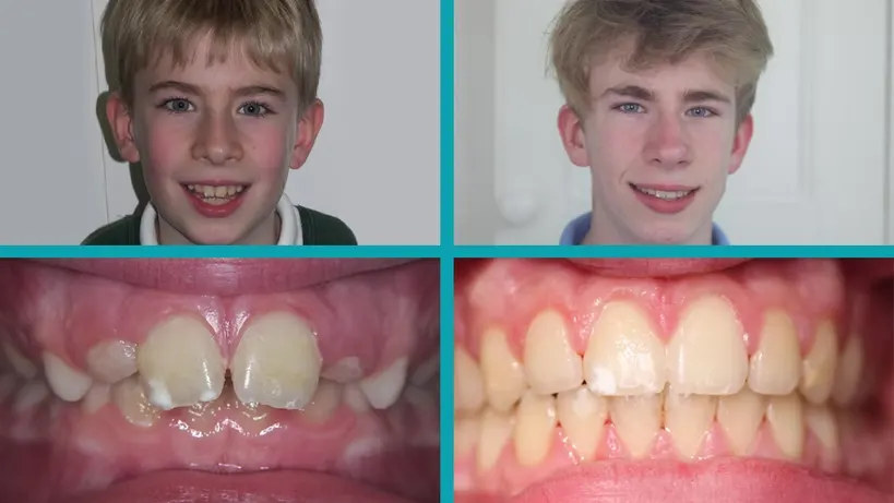 Fixed Braces treatment result