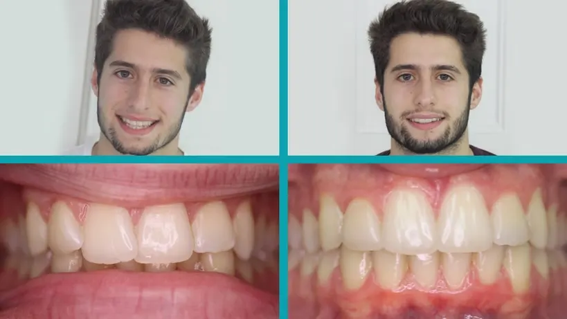 Invisalign treatment result