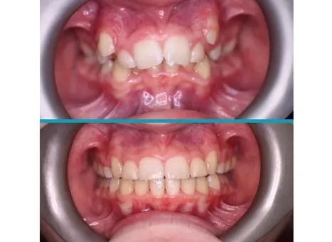 Fixed Braces treatment result