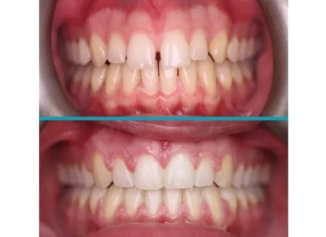 Iconix treatment result