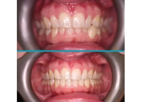 Fixed Braces treatment result