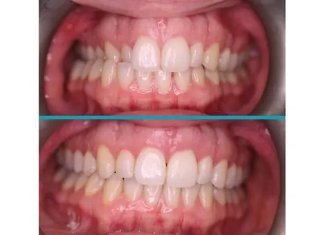 Spark Aligners treatment result
